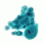 1200px-Serous_carcinoma_2c_-_cytology